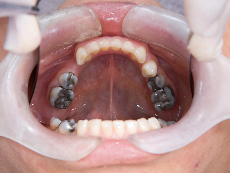 Rehabilitación Oral