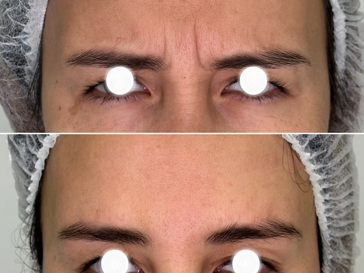 Después del tratamiento de toxina botulínica