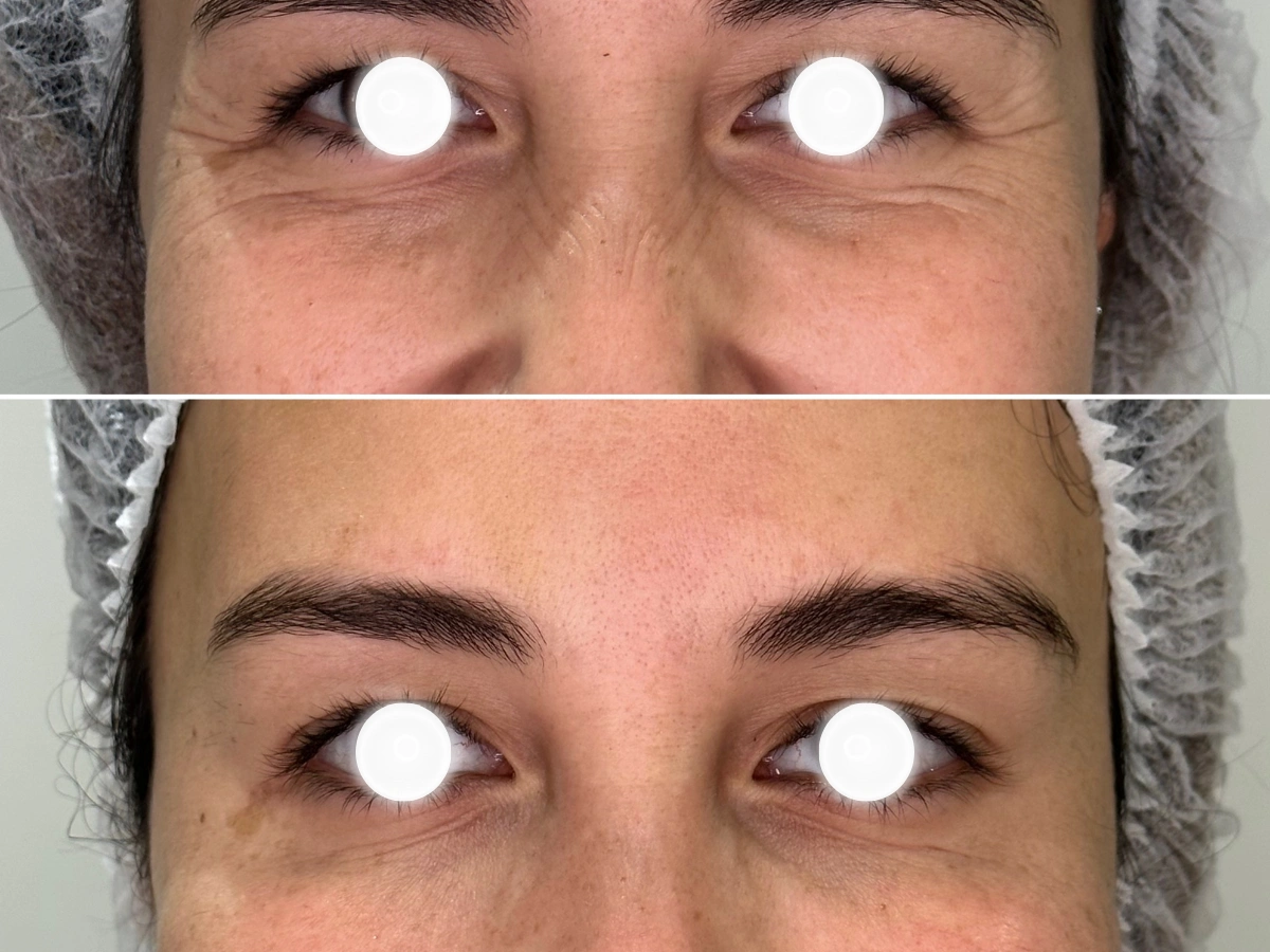 Antes del tratamiento de toxina botulínica