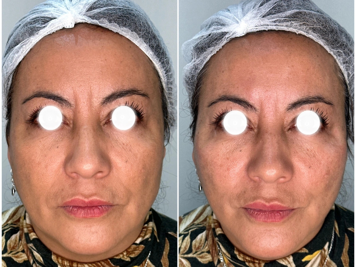 Después del tratamiento con ácido hialurónico