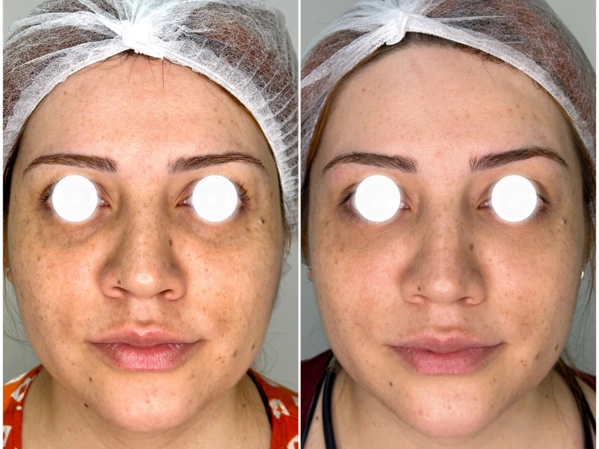 Antes del tratamiento con ácido hialurónico