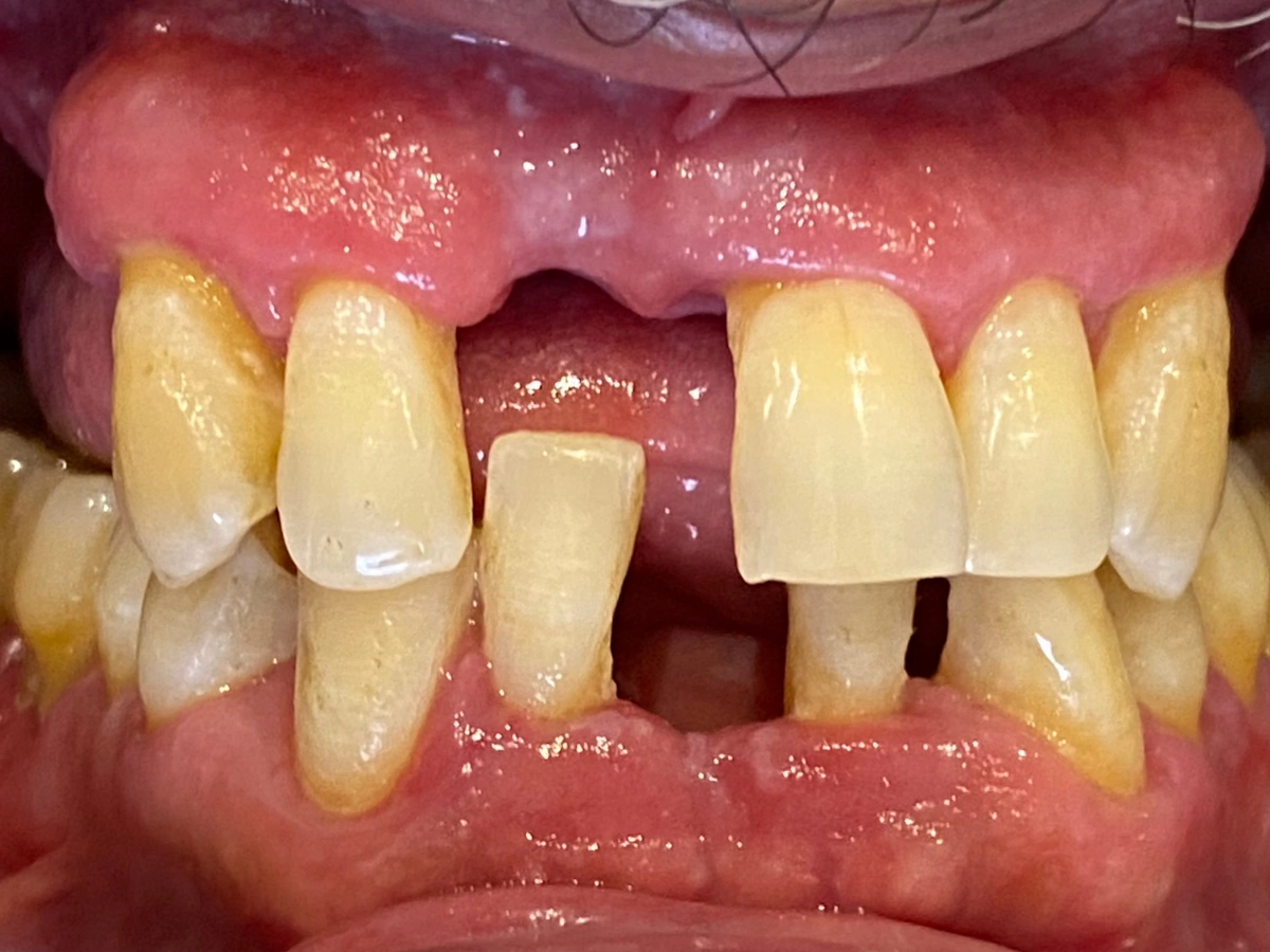 Antes rehabilitación protésica