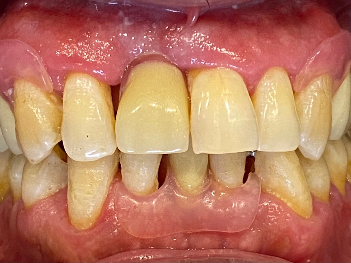 Después rehabilitación protésica