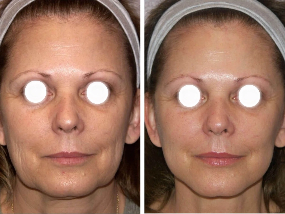 Después del tratamiento con hilos tensores