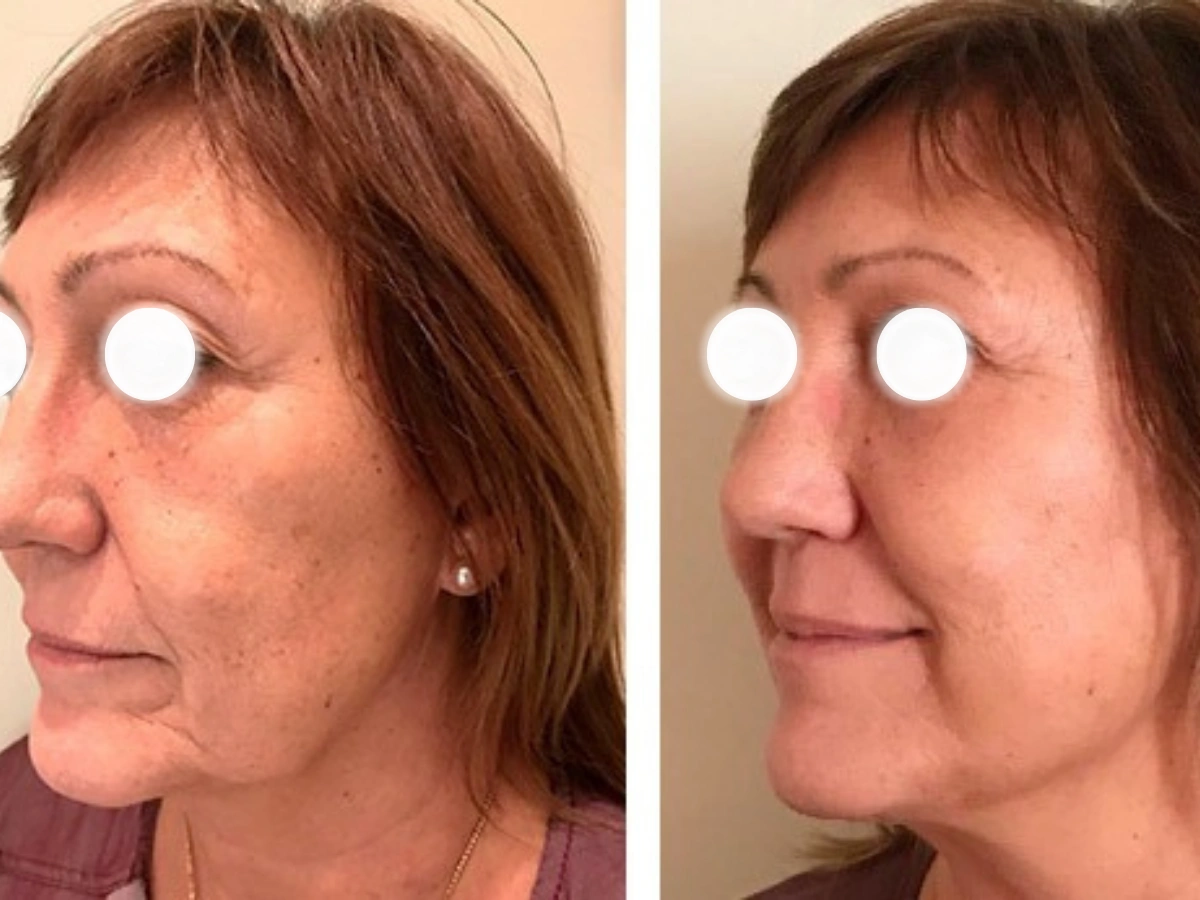 Antes del tratamiento con hilos tensores