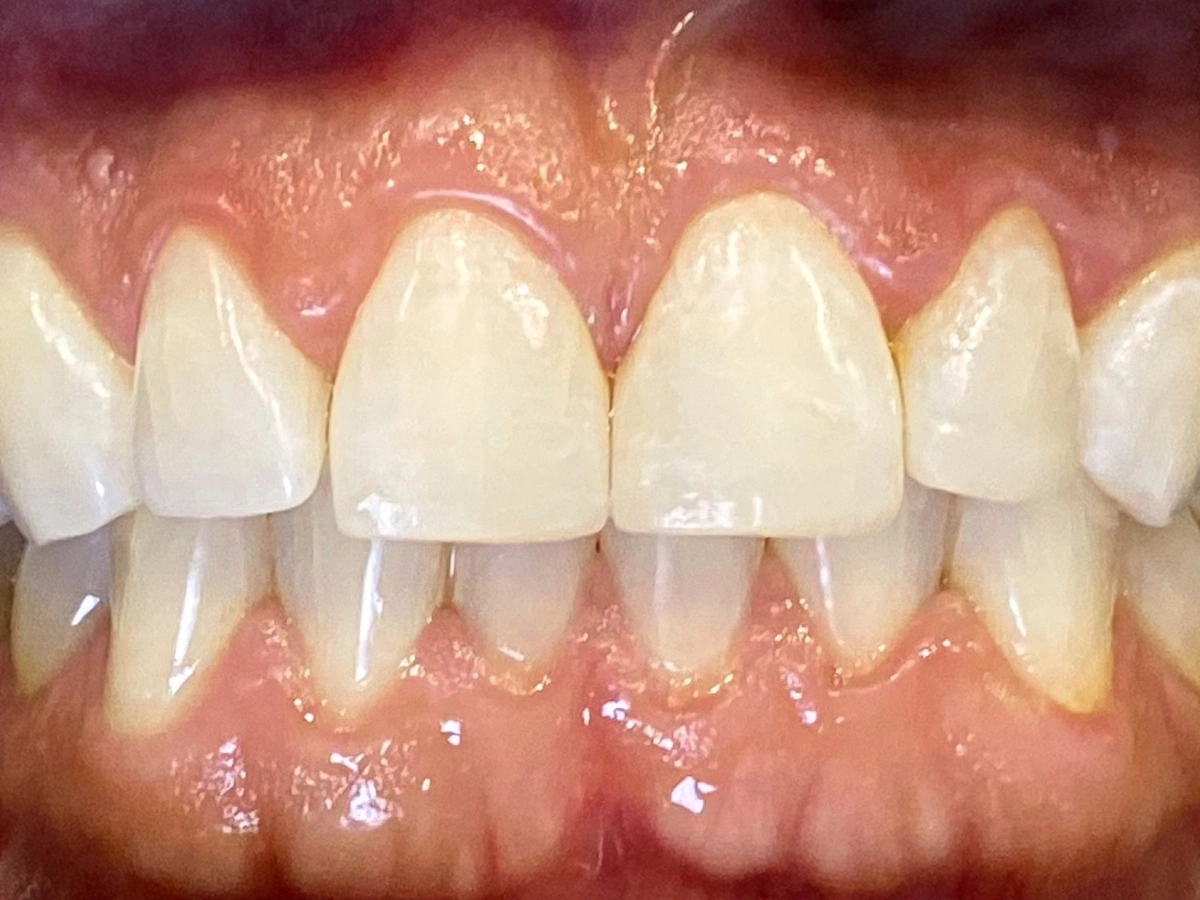 Después del tratamiento