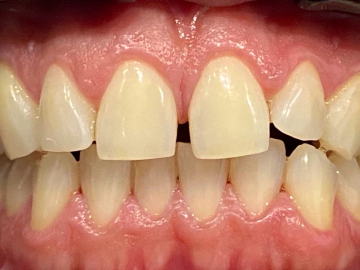 Antes del tratamiento